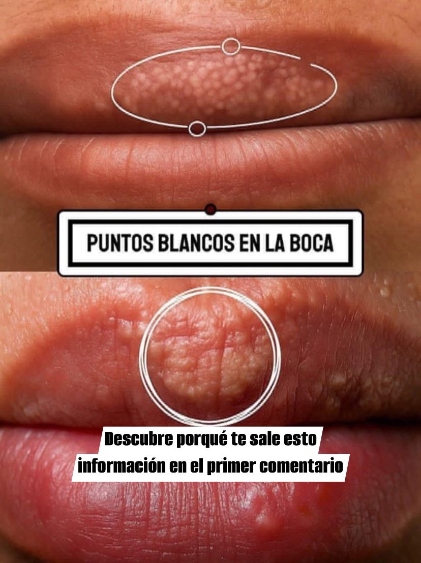Puntos blancos en la boca