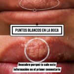 Puntos Blancos en la Boca: Causas y Remedios Naturales