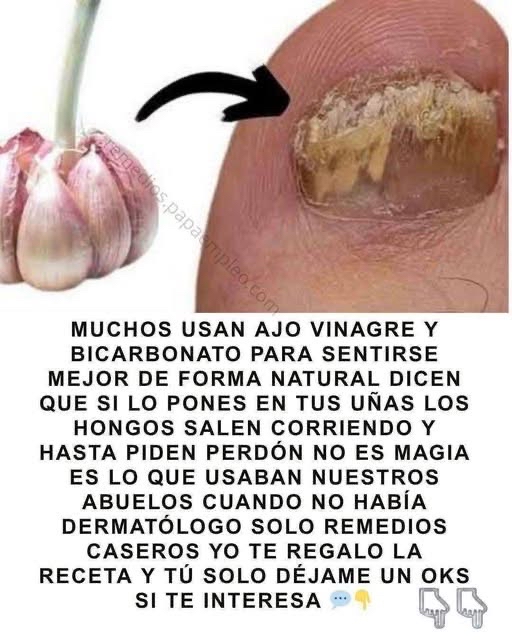 Remedio Natural para Hongos en las Uñas
