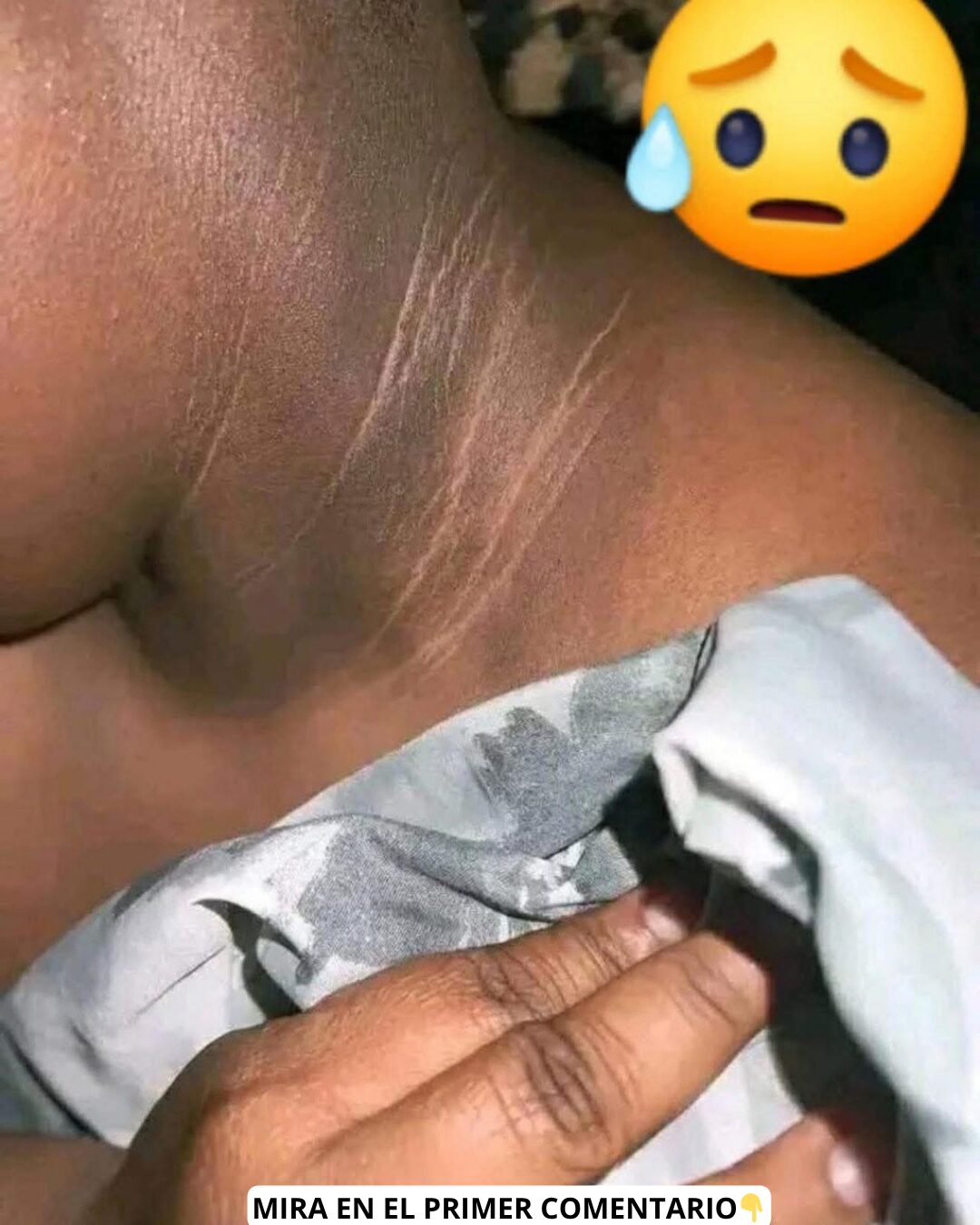 Cuello negro como signo de problemas de salud