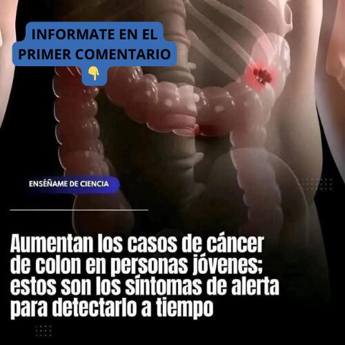 Representación gráfica del colon humano resaltando el área del cáncer