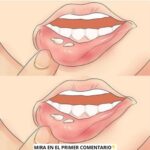 Herpes Labial: Ampollas o Llagas y Cómo Aliviar los Síntomas con Remedios Caseros