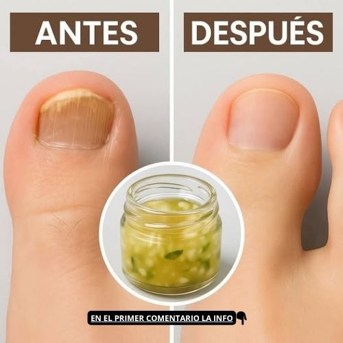 Antes y Después de tratamiento para hongos en los pies