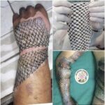 La Revolucionaria Piel de Tilapia: Cicatrización Natural para Quemaduras