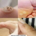 ¡Cuidado! ¿Estás Infectado con Verrugas? Descubre Cómo Tratarlo de Forma Natural