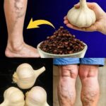 Remedios Naturales para el Dolor de Piernas: Ajo y Clavos de Olor