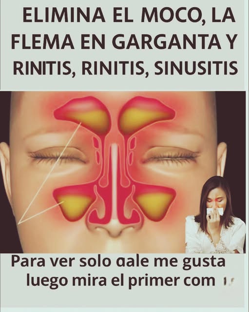 Remedios caseros para la rinitis