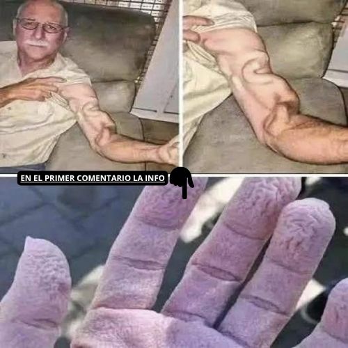 Dolor Agudo en el Brazo