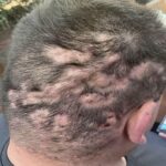 Primera Guía sobre los Síntomas de Problemas en el Cuero Cabelludo y Remedios Naturales