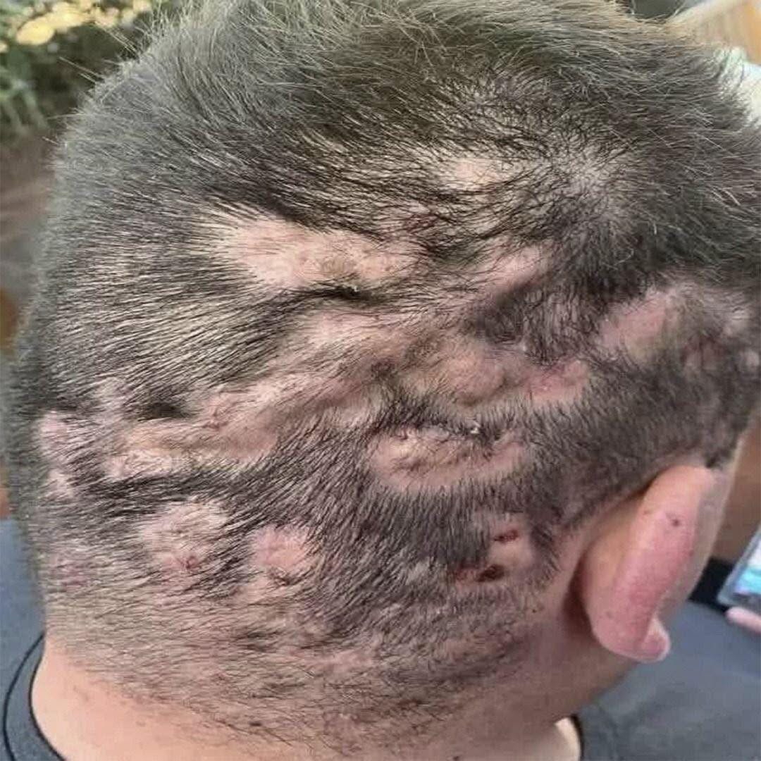 Cuero cabelludo con lesiones inflamadas