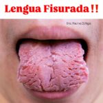 Todo Lo Que Necesitas Saber Sobre la Lengua Fisurada