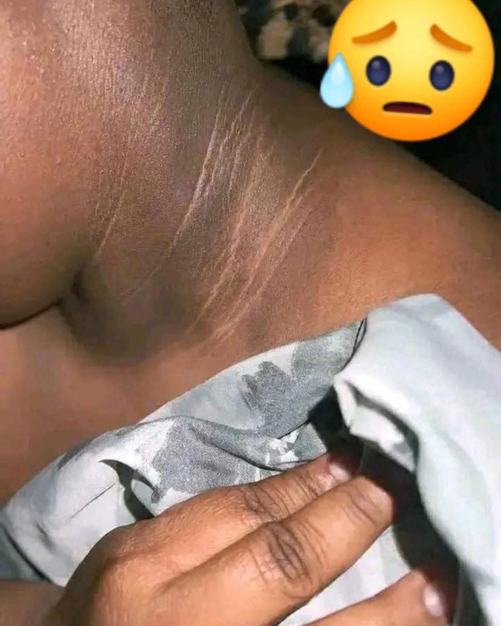 Imagen de cuello afectado