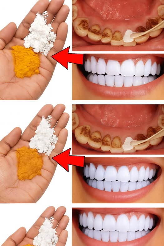 Proceso de blanqueamiento dental con bicarbonato de sodio y cúrcuma