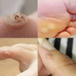 Verrugas en la Piel: Síntomas, Causas y Remedios Naturales