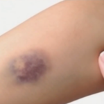 ¿Por qué aparecen moretones sin haberme golpeado? Causas y remedios naturales