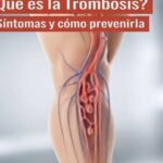 Todo lo que Necesitas Saber sobre la Trombosis: Síntomas y Prevención