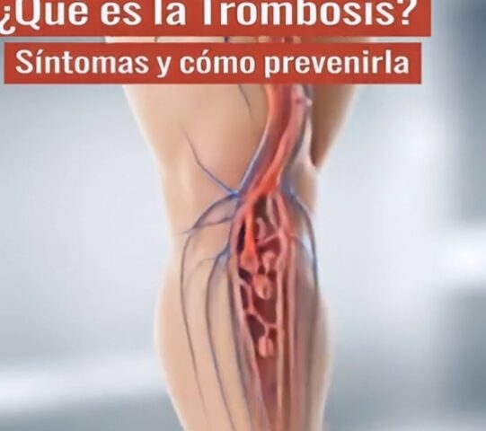 Síntomas de la Trombosis