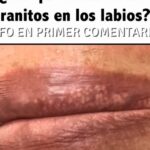 Las Manchas y Granos Blancos en Labios y Zonas Íntimas: Causas y Remedios Caseros
