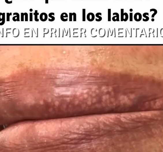 Pápulas de Fordyce