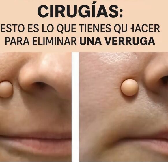 Remedios naturales para verrugas