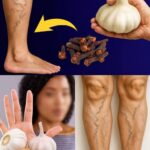 Remedios Naturales para Aliviar el Dolor de Piernas y Venas Varicosas