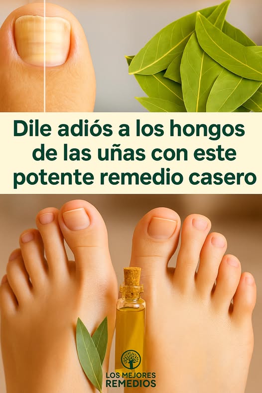 Remedio Natural para Hongos en las Uñas