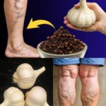 Remedios Naturales: Alivio para el Dolor de Piernas, Várices y Artritis