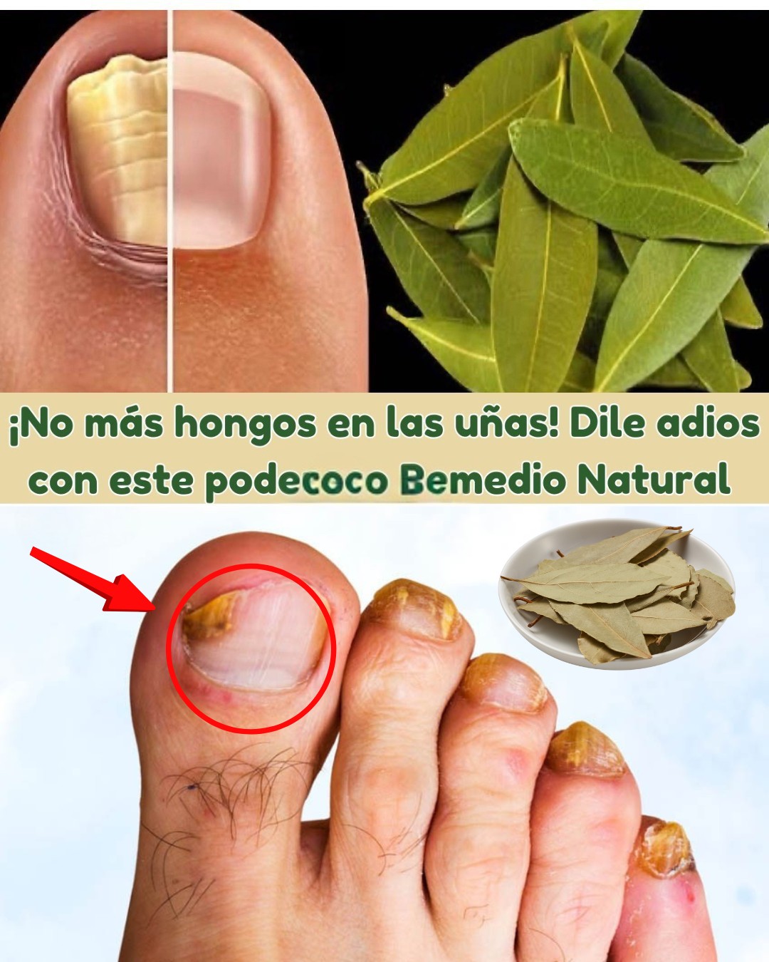 Antes y después del tratamiento con laurel para hongos en las uñas