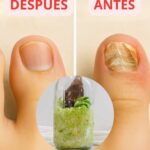 Adiós a los Hongos: Remedios Caseros para Pies y Uñas
