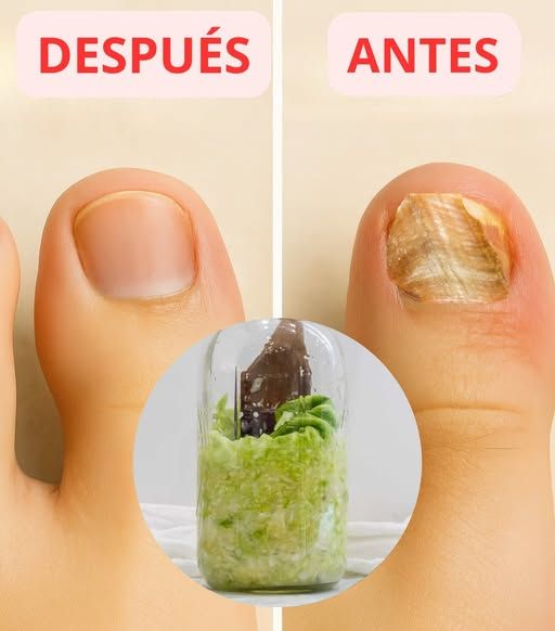 Antes y después del tratamiento casero para hongos en los pies y uñas