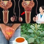 Ningún Hombre Debería Morir de Cáncer de Próstata: Un Poderoso Remedio Natural