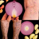 Eliminador de Venas: Remedio Natural de Cebolla y Ajo para Várices