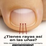 Rayas Verticales en las Uñas: Lo Que Significan y Cómo Actuar