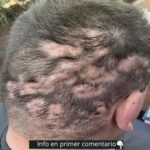 Los Primeros Síntomas de Afecciones del Cuero Cabelludo y Remedios Naturales