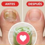 Adiós a los Hongos: Remedios Caseros Antimicóticos para Pies y Uñas Saludables