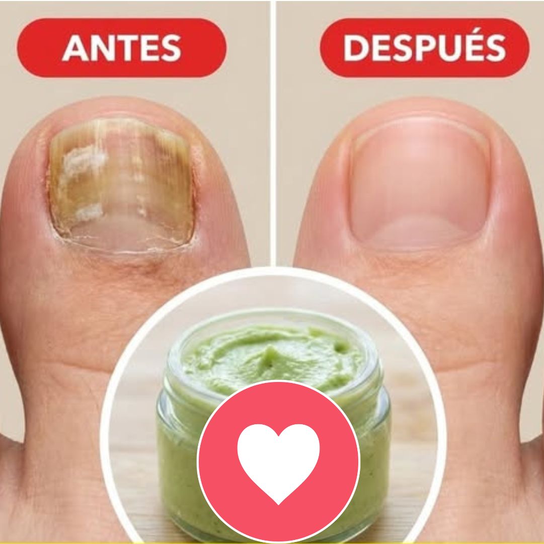 Remedio casero para hongos en pies y uñas