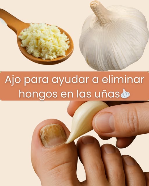 Ajo para ayudar a eliminar hongos en las uñas