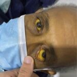 Las Consecuencias de Dormir con Ictericia: ¿Por Qué Tus Ojos Pueden Volverse Amarillos?