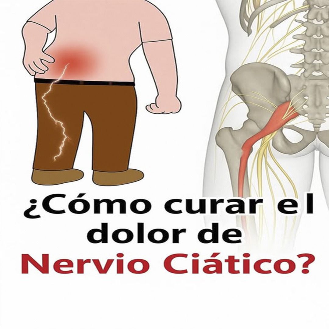Ilustración de la ubicación del nervio ciático