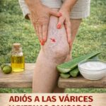 Eliminar las Várices de Forma Natural con Esta Mezcla Casera