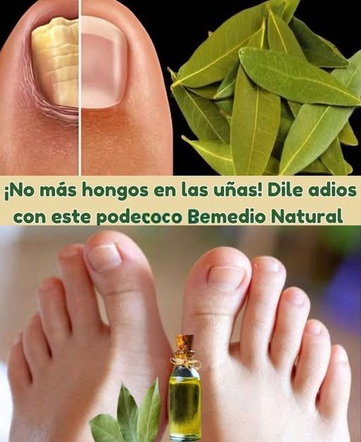 Remedio natural para hongos en las uñas