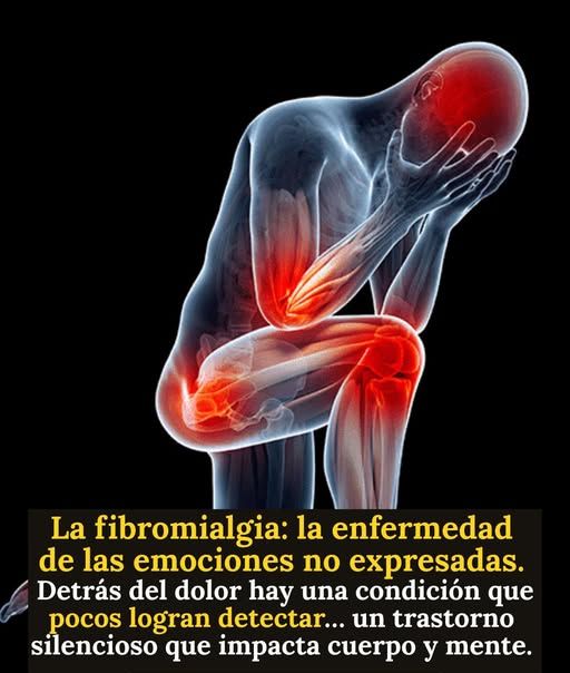 Ilustración de las áreas de dolor en la fibromialgia