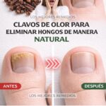 Remedios Naturales para Hongos de Uñas: La Solución Efectiva con Clavos de Olor