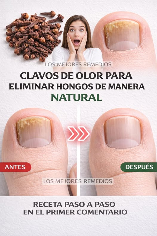 Remedio natural para hongos en las uñas con clavos de olor