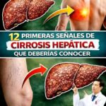 12 Señales de Cirrosis Hepática y Cómo Proteger Tu Hígado