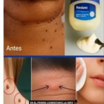 Remedio Casero con Vaselina para Eliminar Verrugas