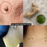 Las Verrugas Caen Como Hojas con Este Tratamiento Casero