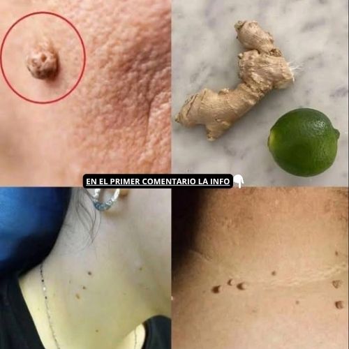 Tratamiento casero para verrugas