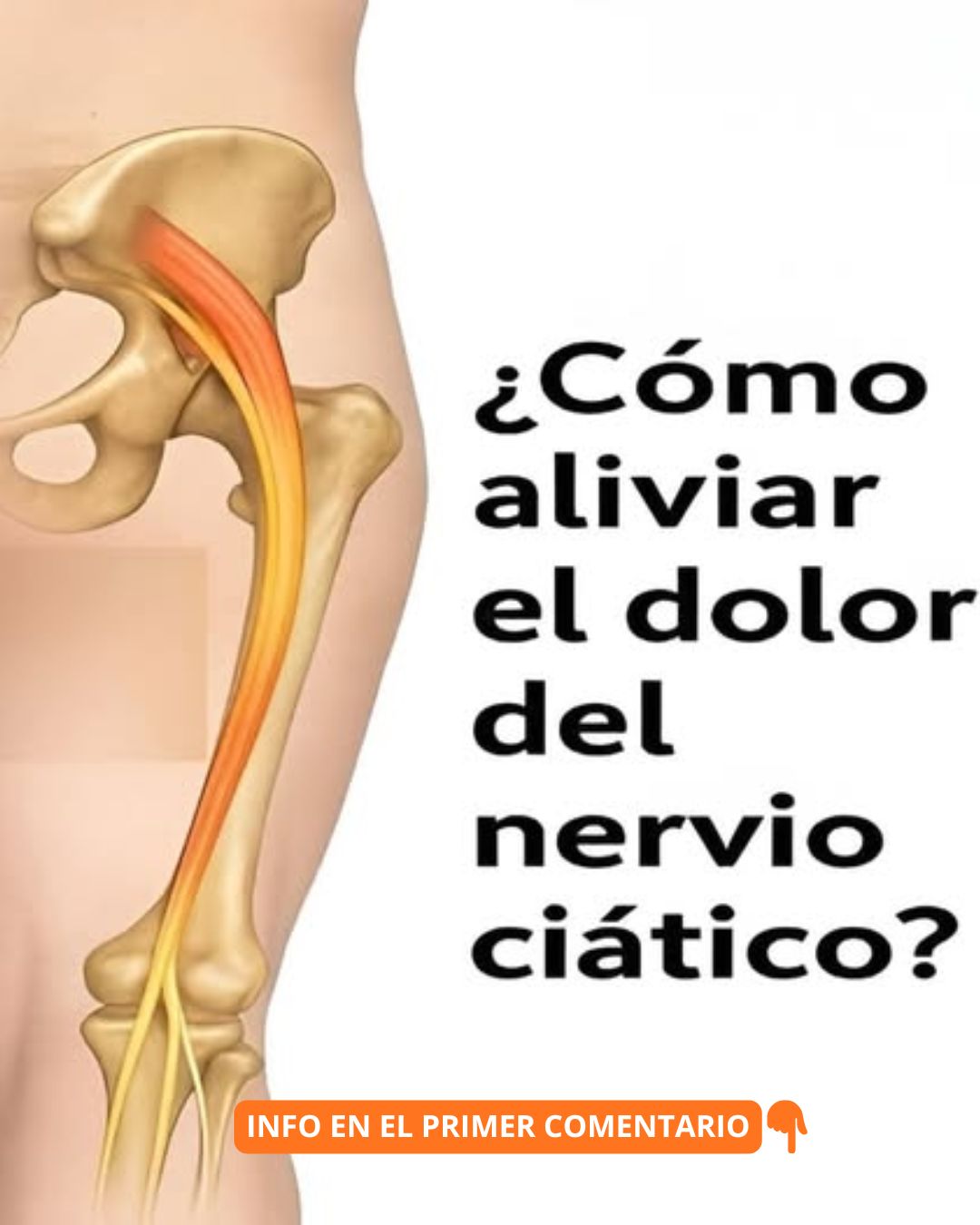 Diagrama del cuerpo humano con nervio ciático destacando