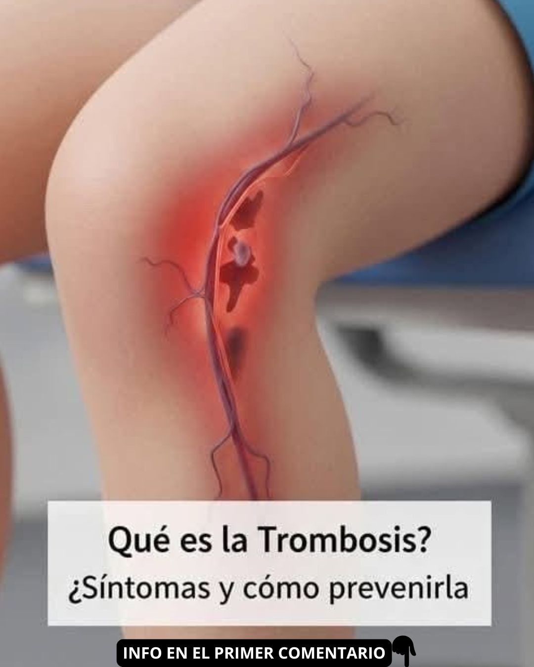 Trombosis: Coágulo en una Vena